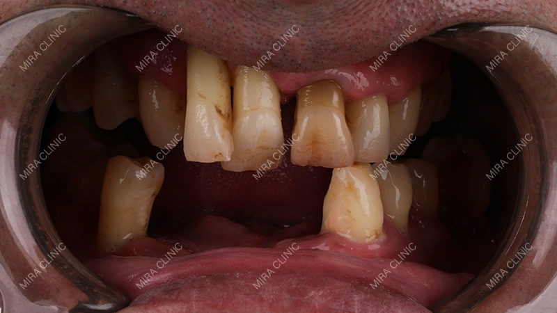 Dental implants for Missing most teeth